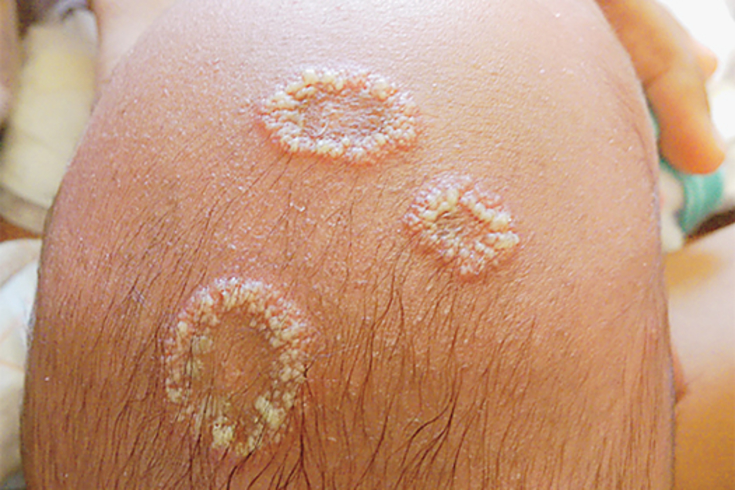 Tinea capitis