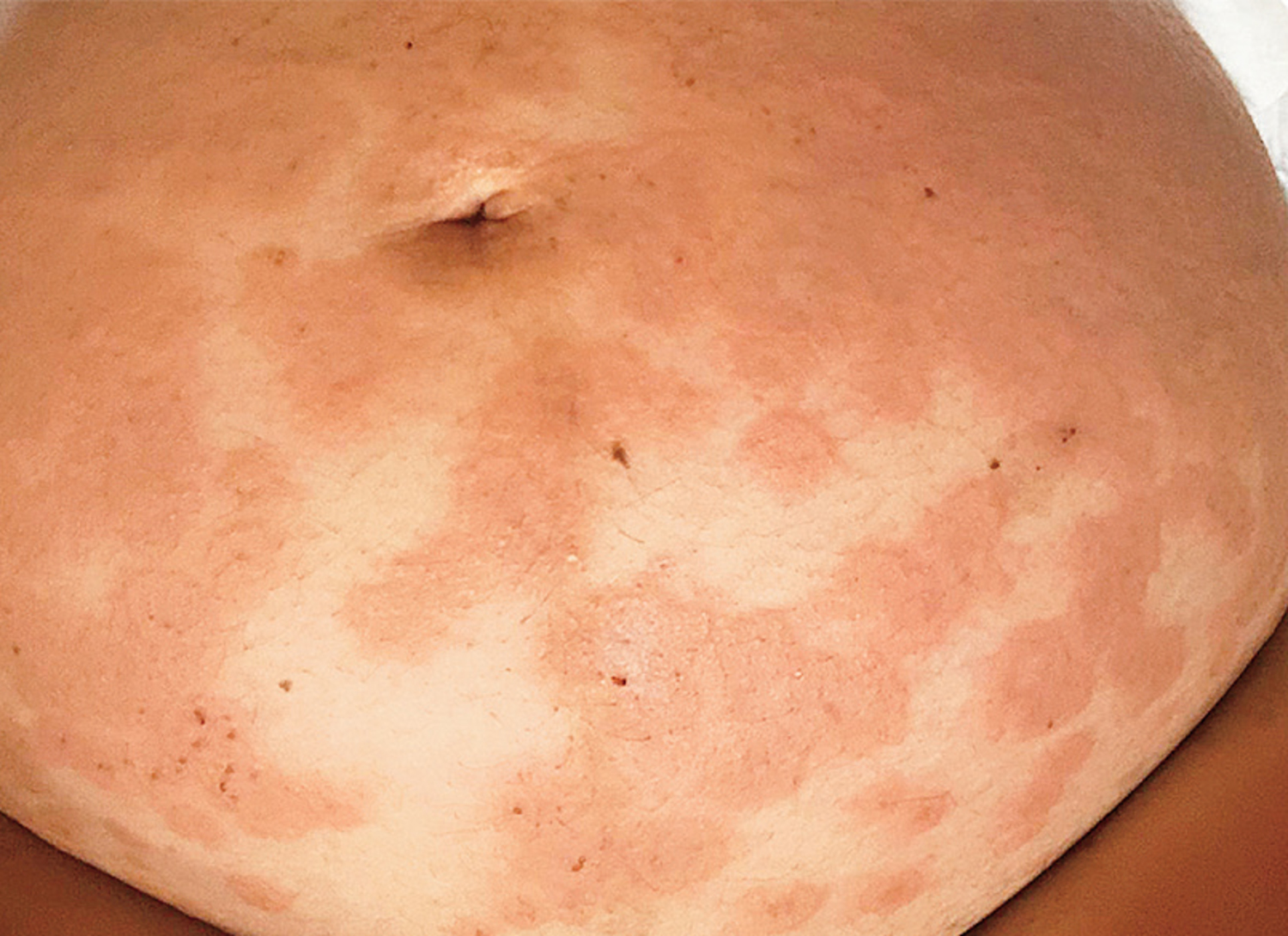 Pemphigoid gestationis