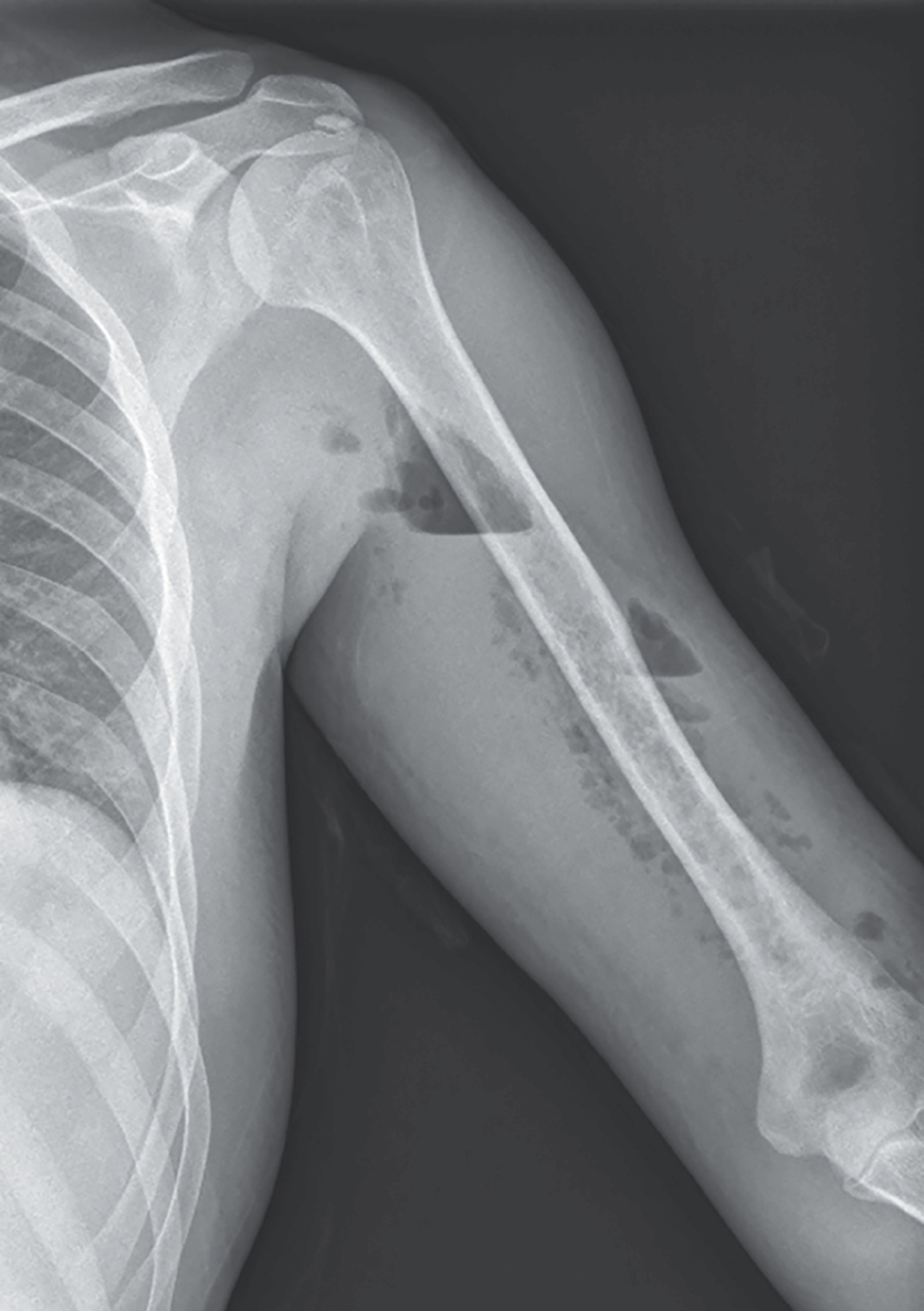 Delay in surgical intervention >24 hours