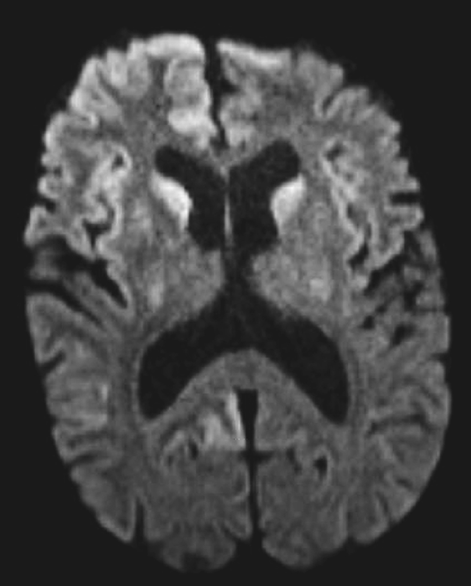 Creutzfeld-Jakob disease