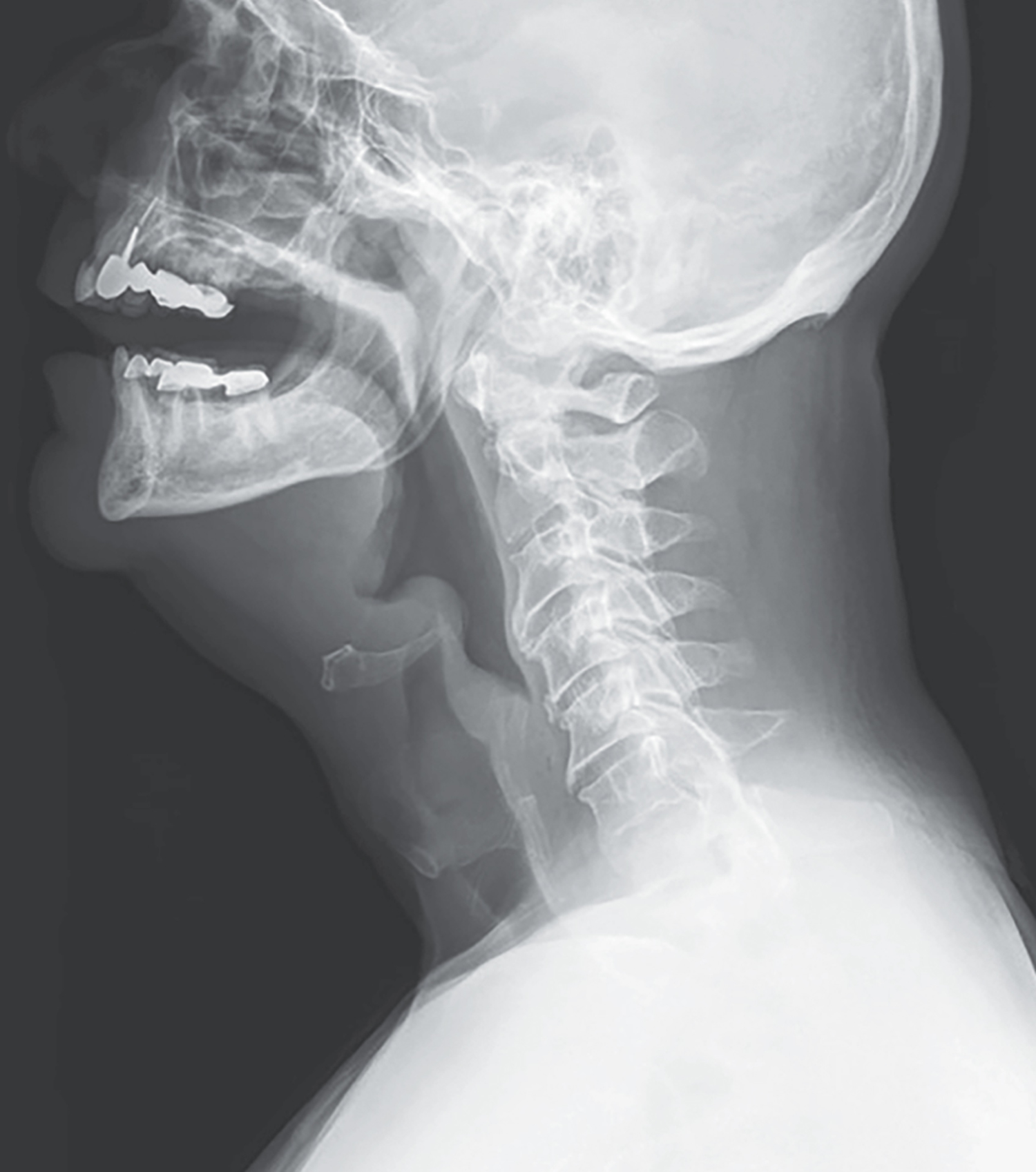 Epiglottitis
