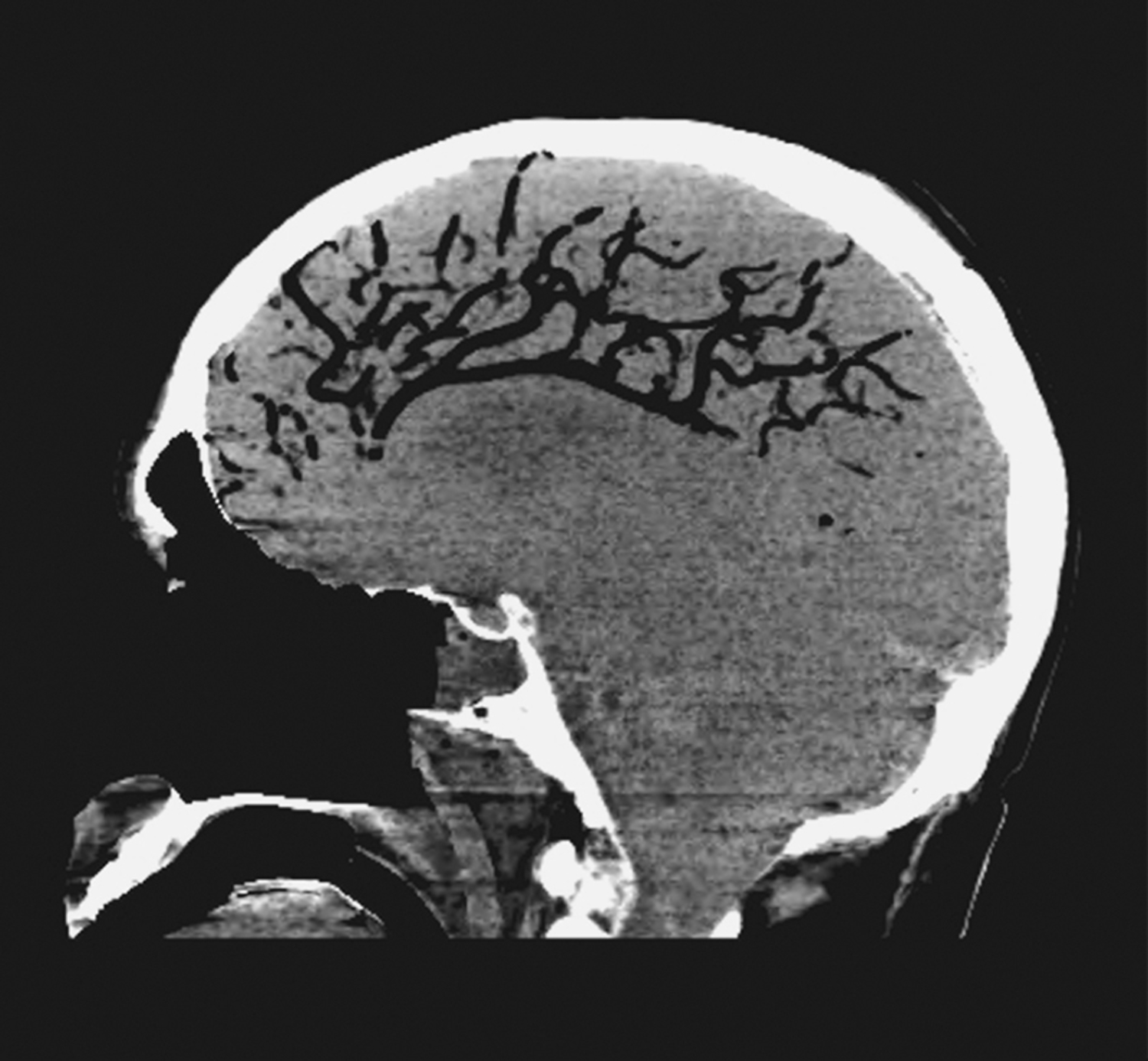 Air embolism