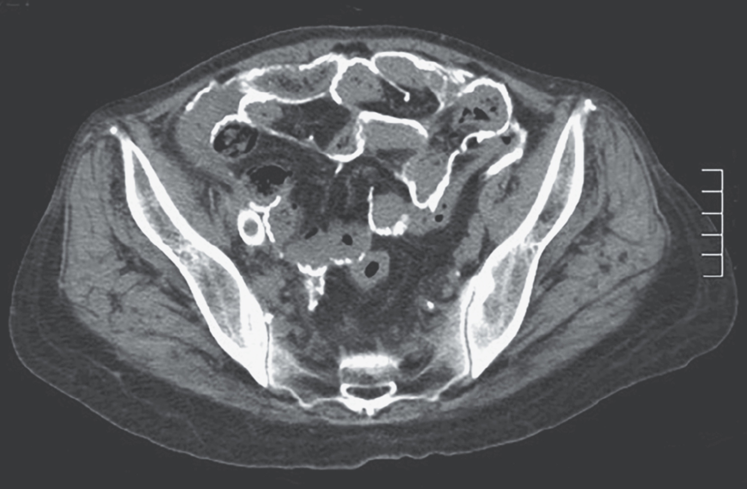 Encapsulating peritoneal sclerosis