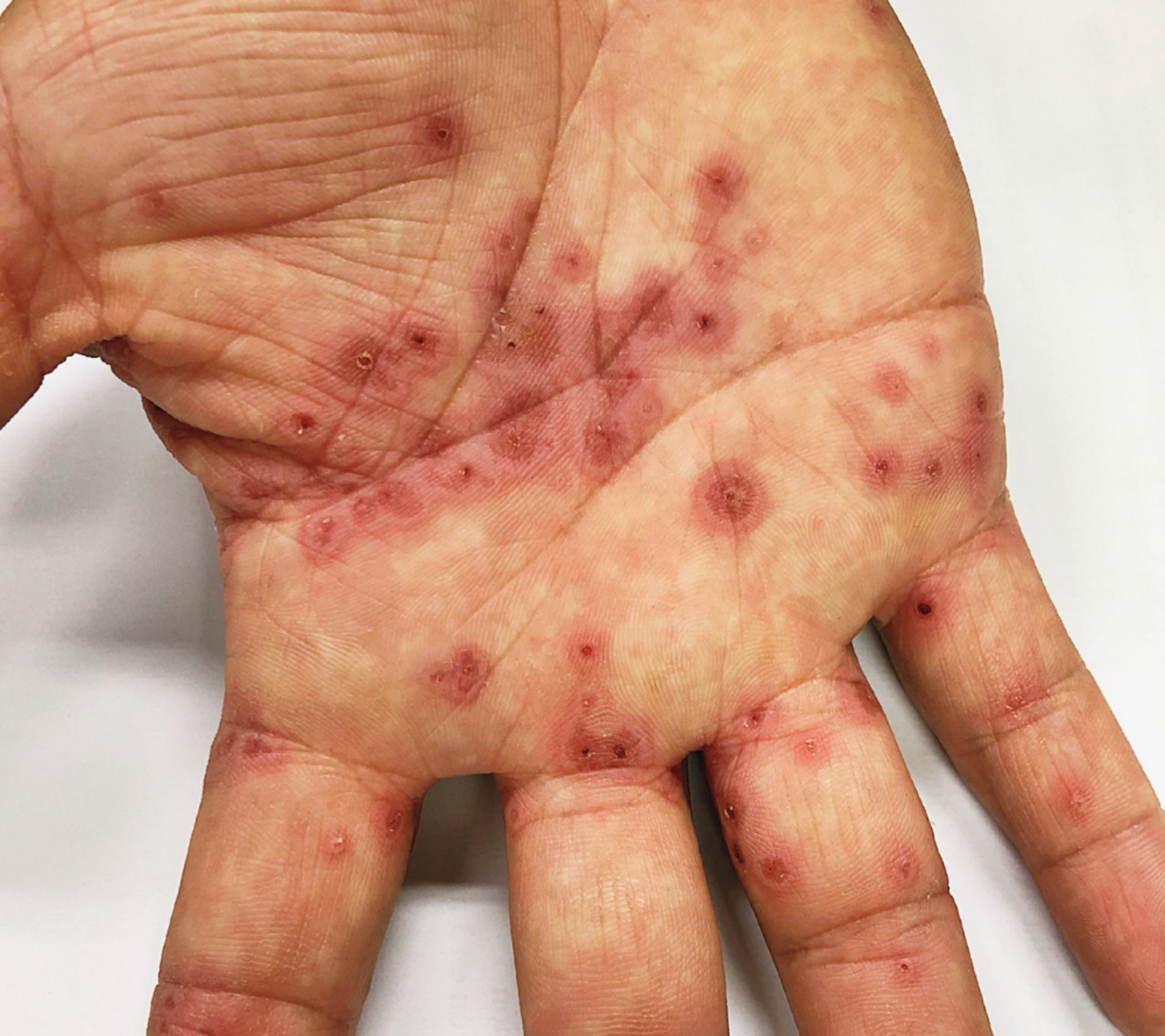 Herpes simplex virus infection