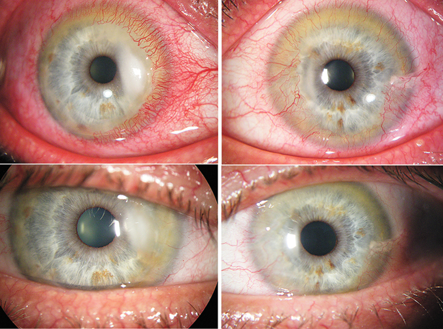 Rosacea
