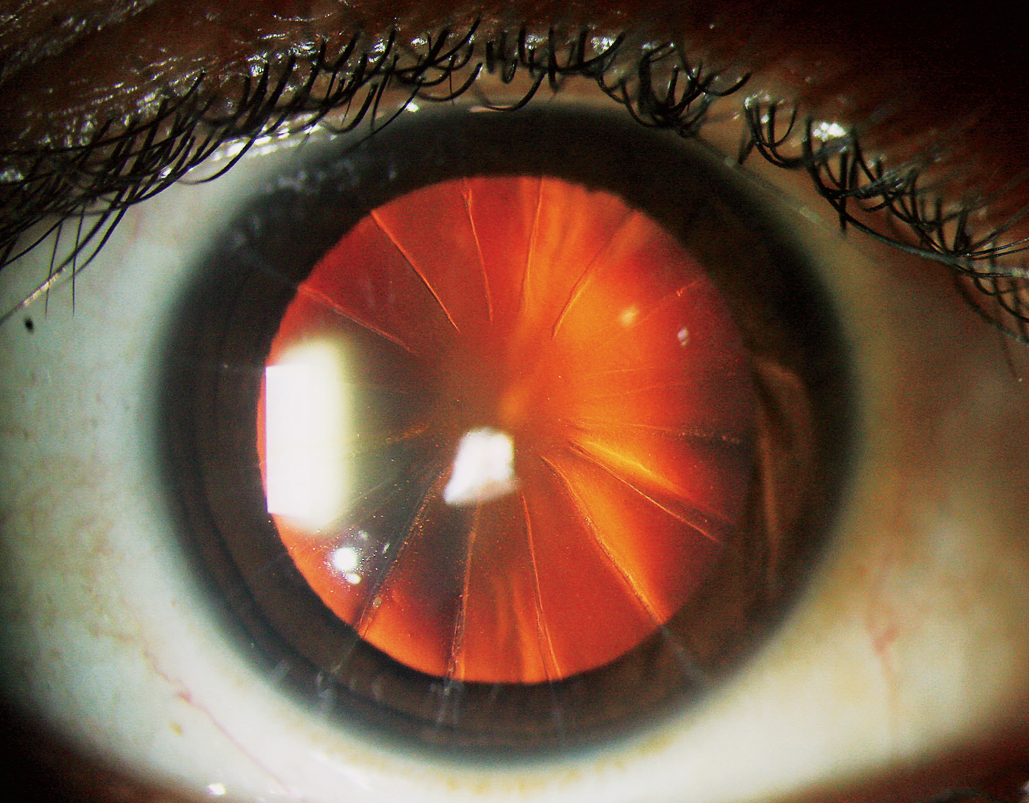 Radial keratotomy