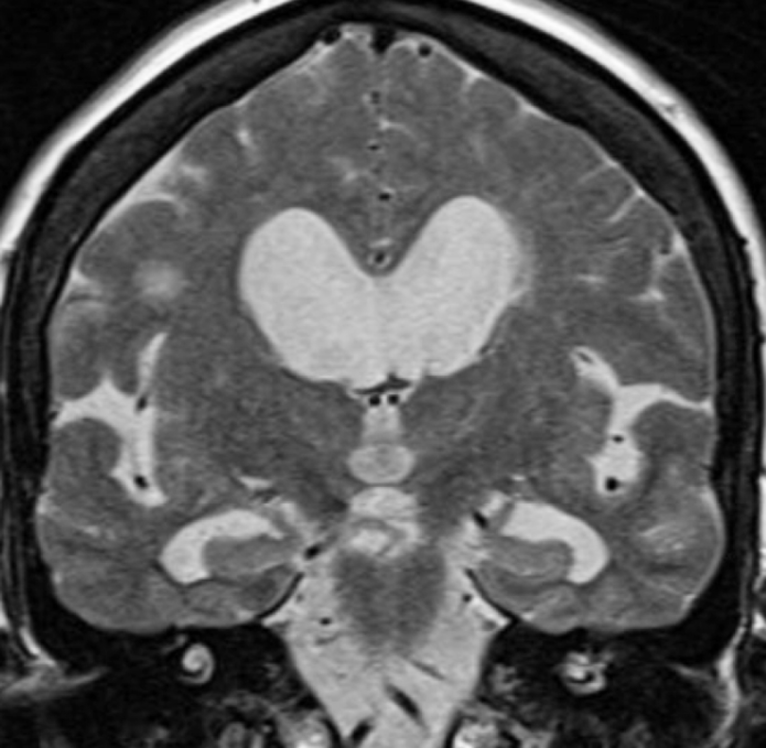Normal-pressure hydrocephalus