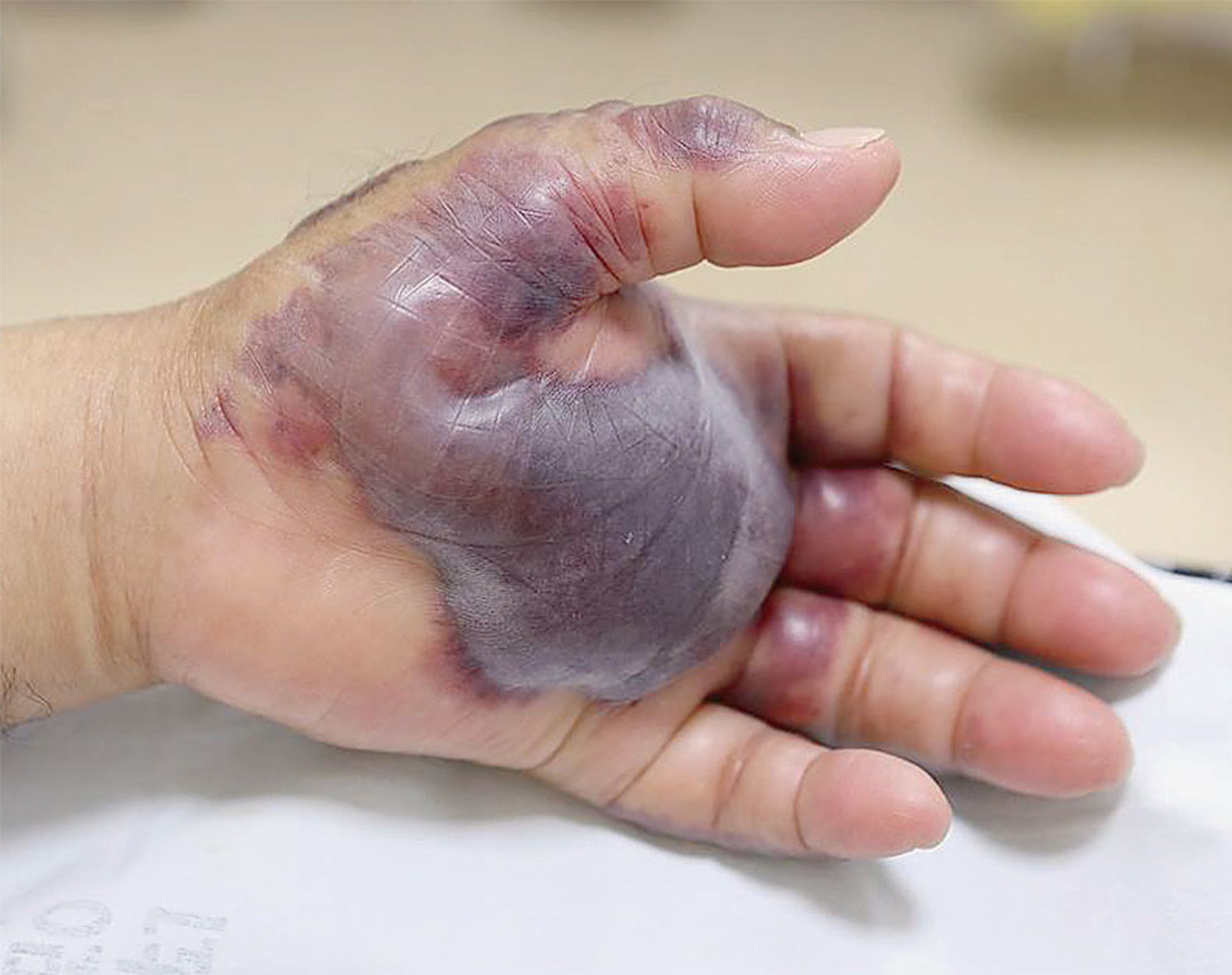 Vibrio vulnificus