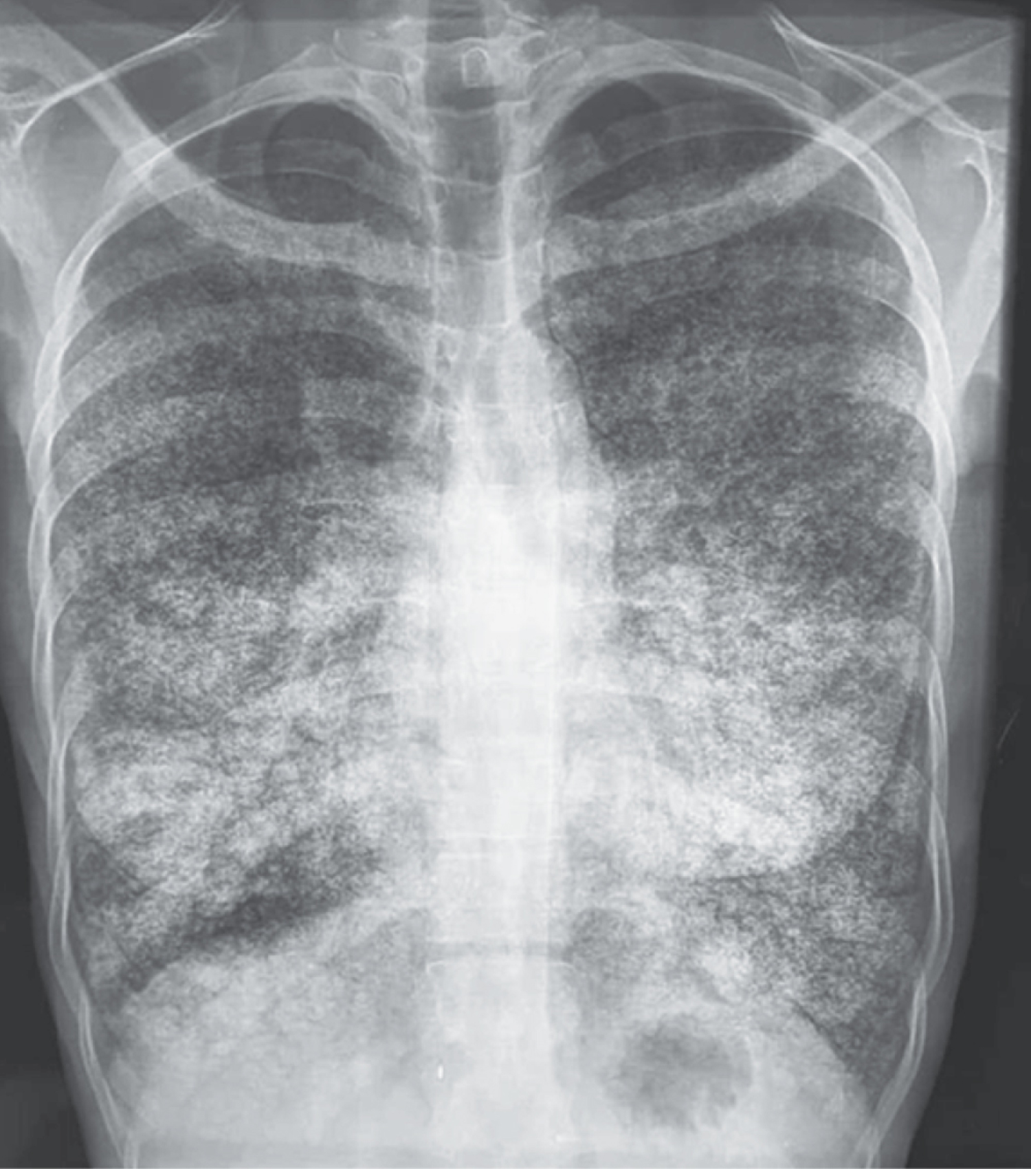 Pulmonary alveolar microlithiasis