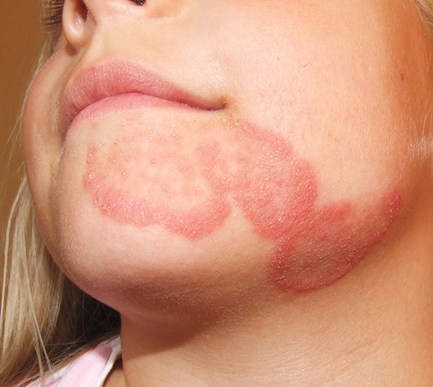 Tinea faciei