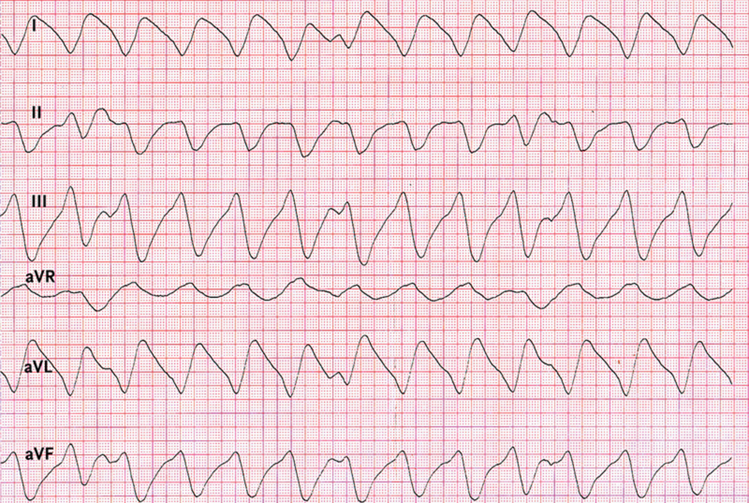 Hyperkalemia