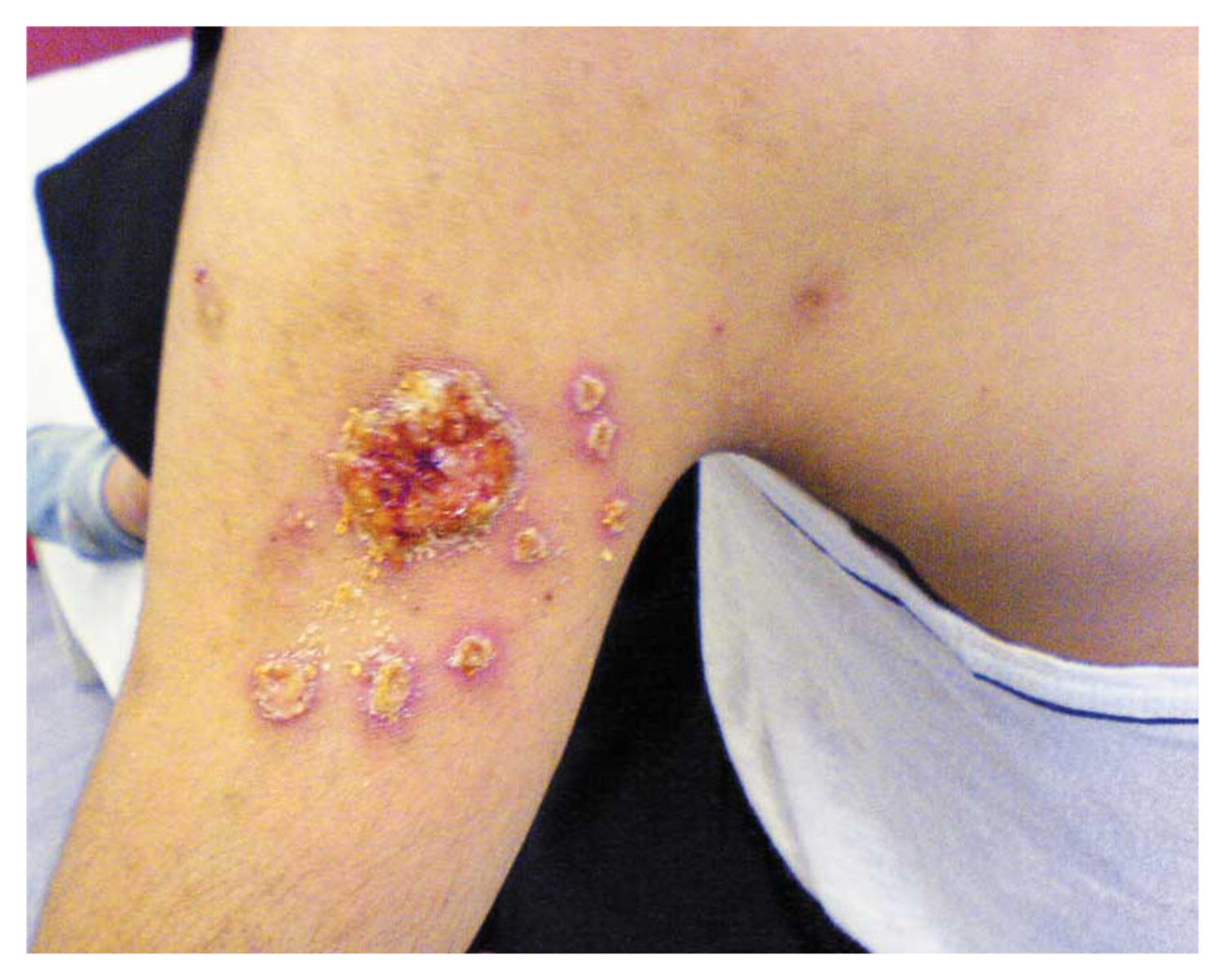 Cutaneous leishmaniasis