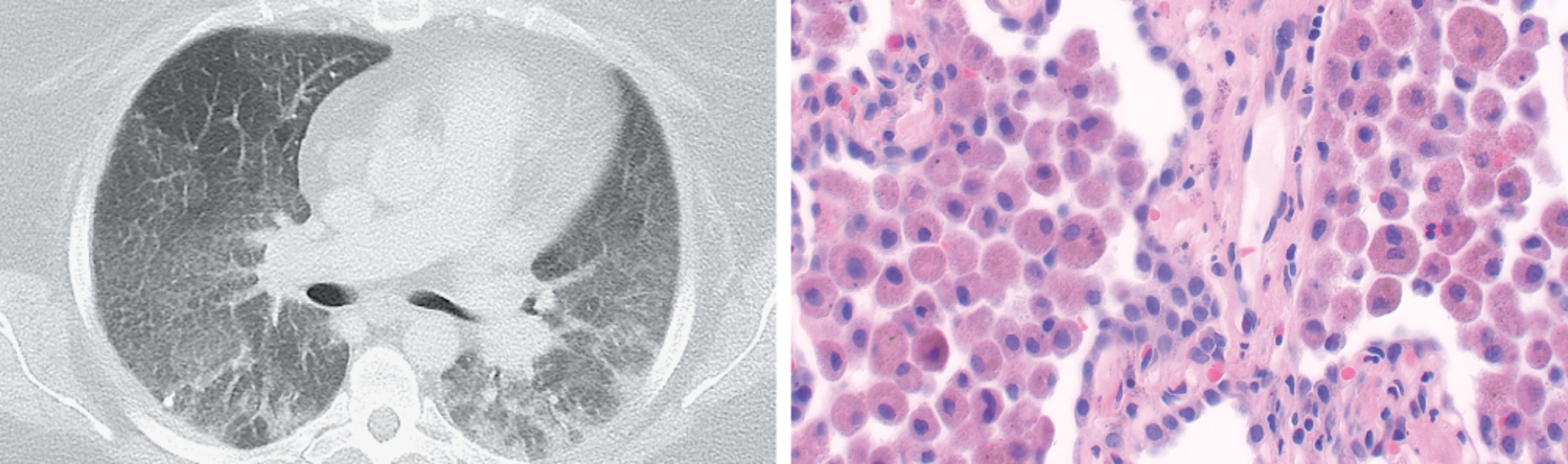 Desquamative interstitial pneumonia
