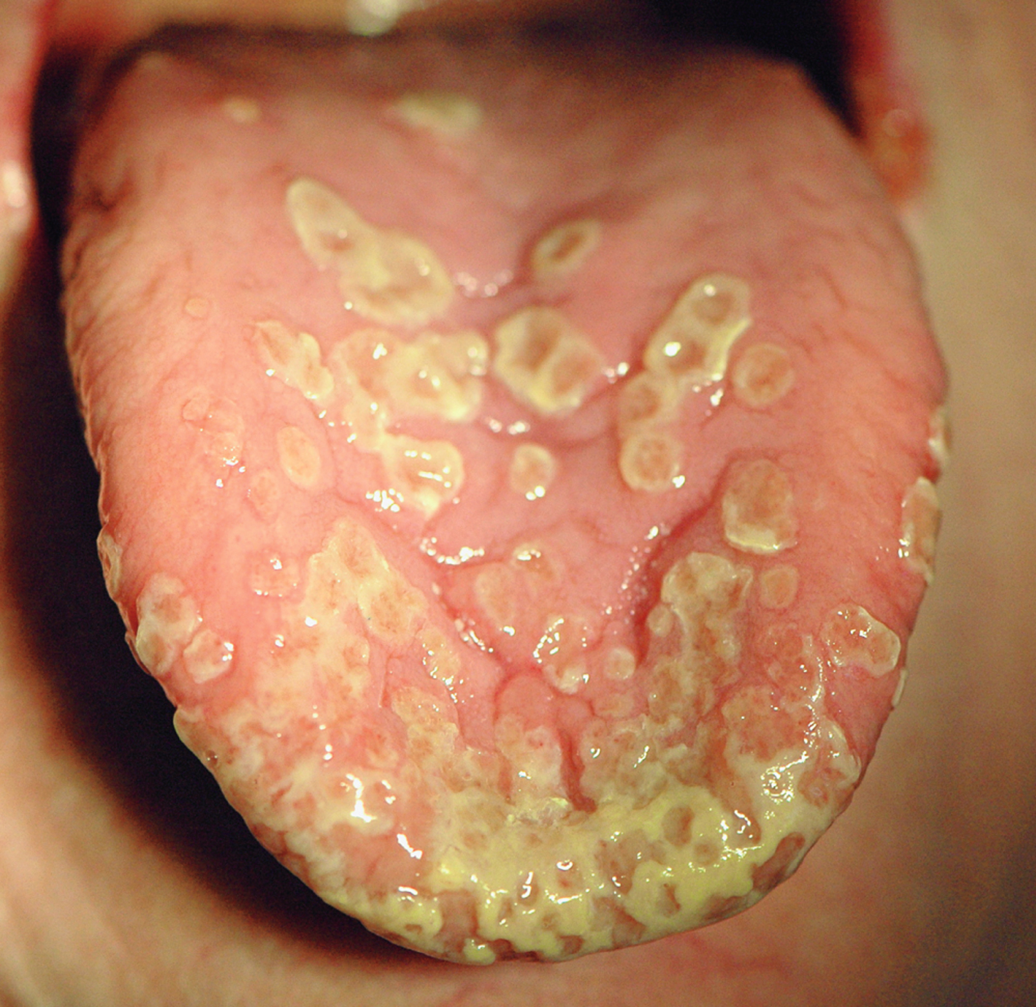 Pyostomatitis vegetans