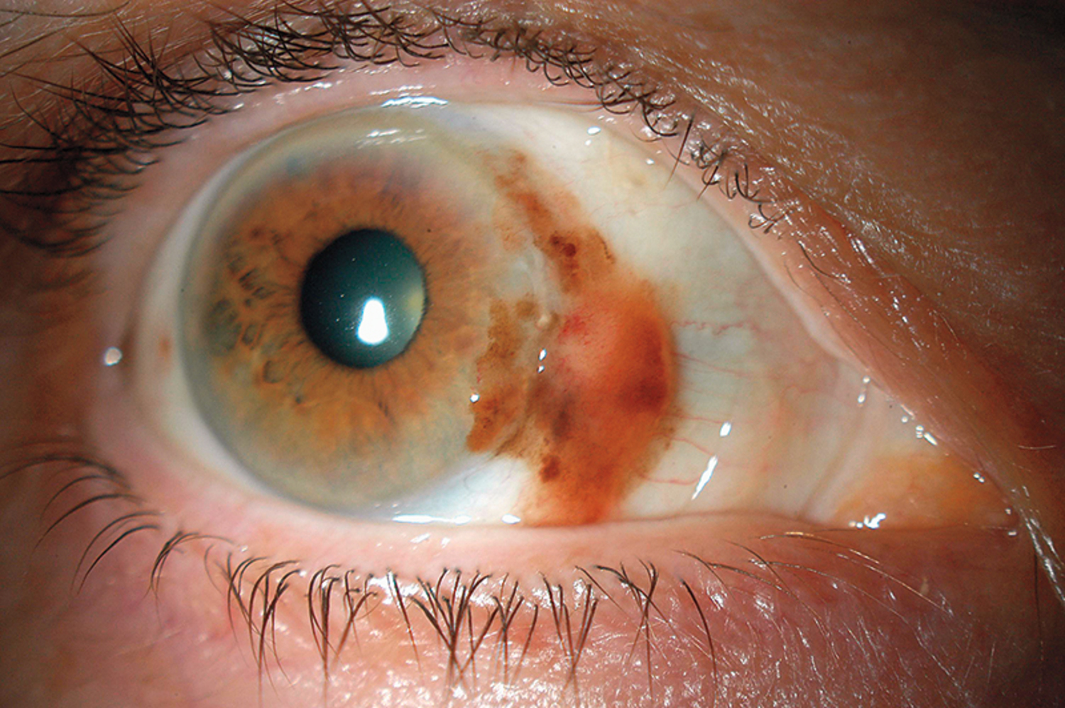 Melanoma