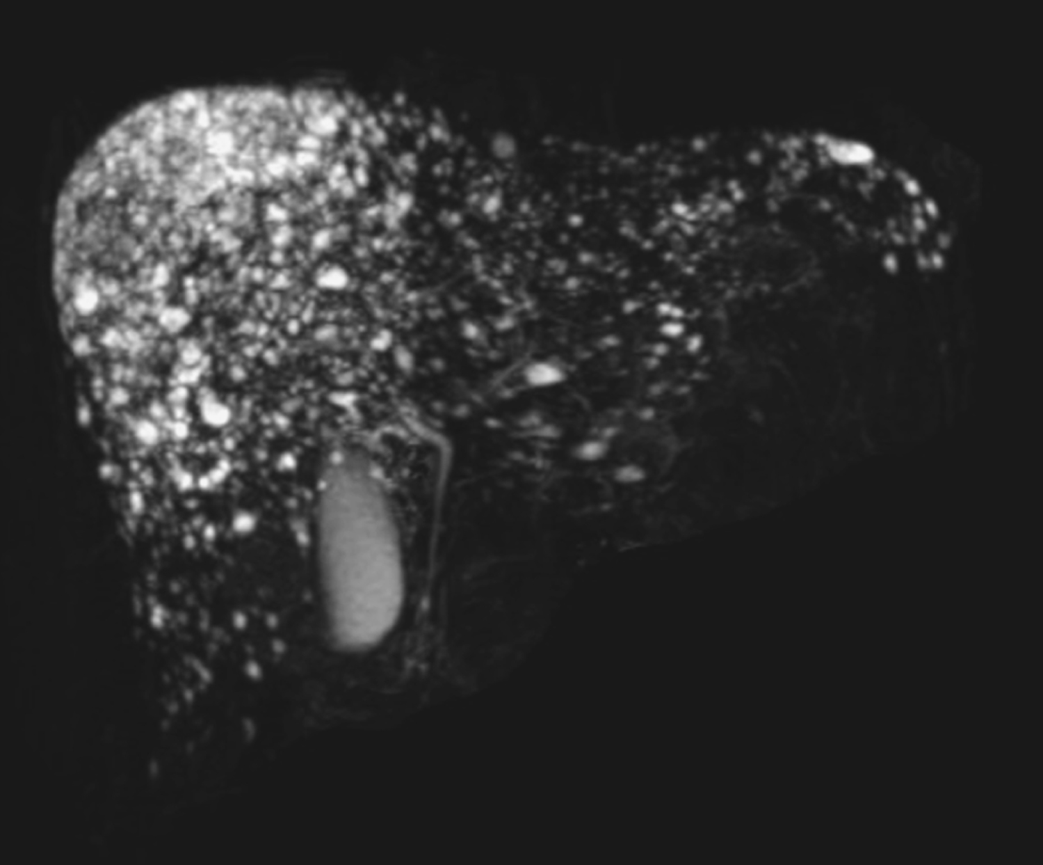 Multiple biliary hamartomas
