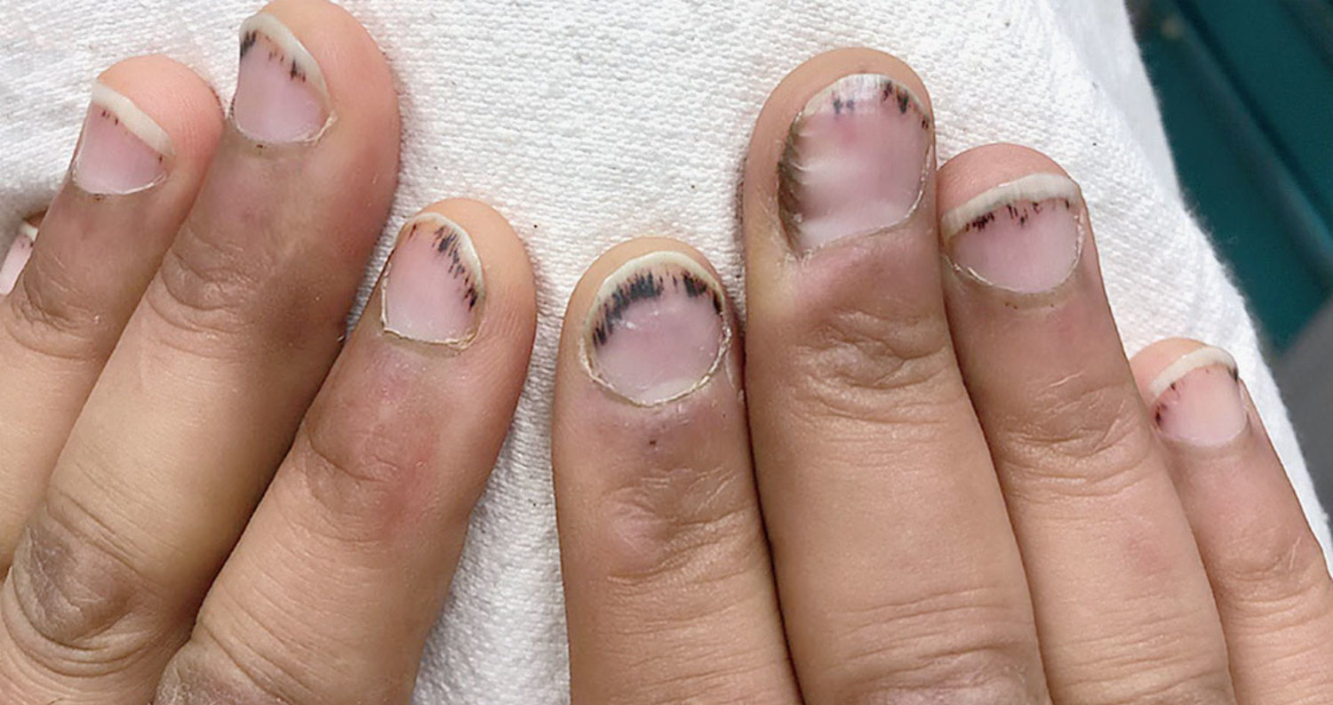 Splinter hemorrhages