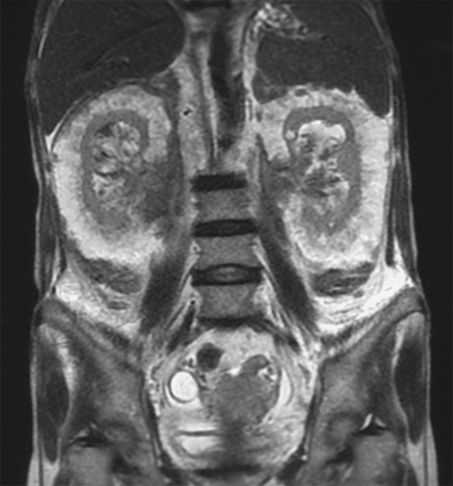 Perirenal extramedullary hematopoiesis