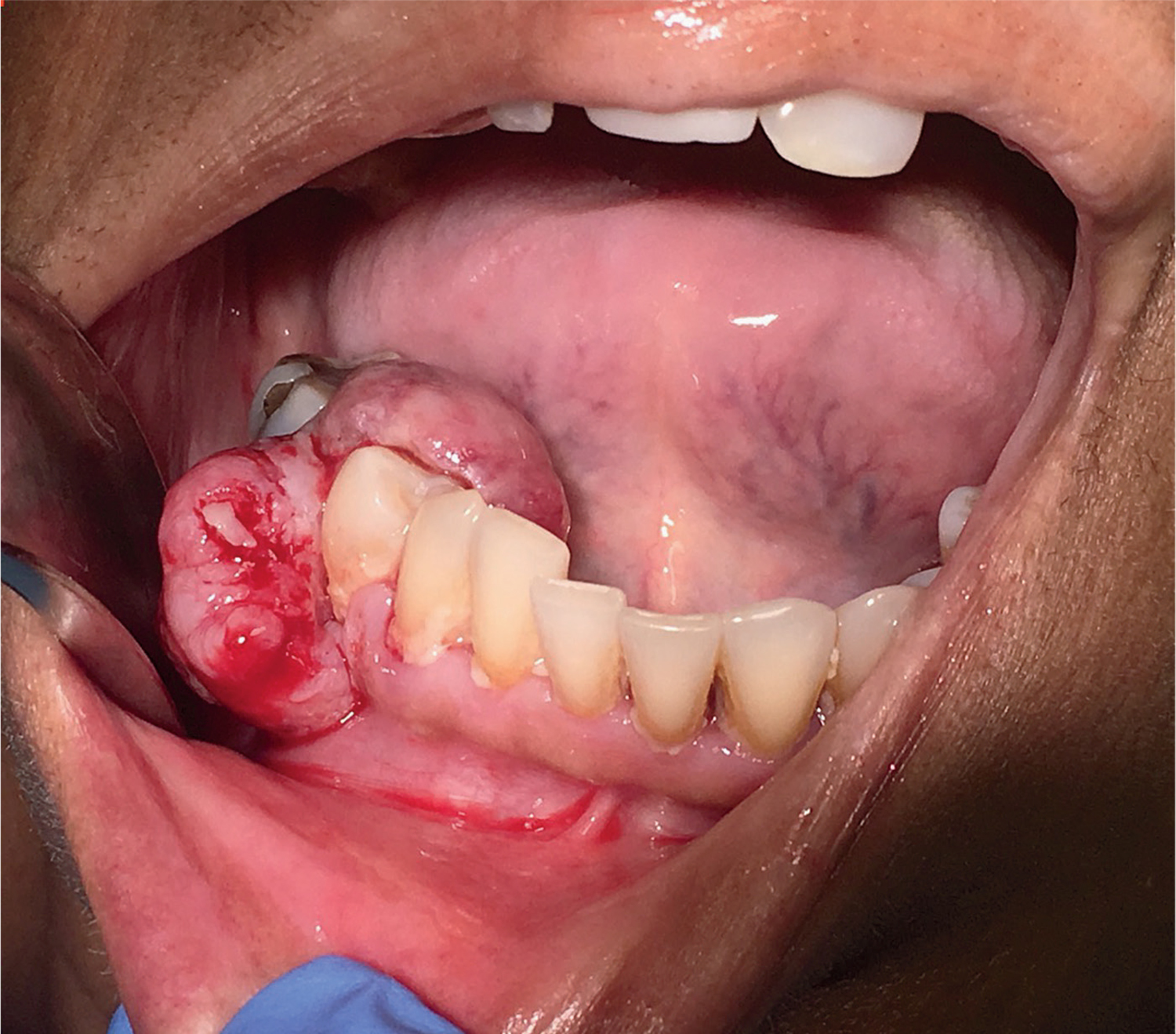 Metastasis of colorectal cancer