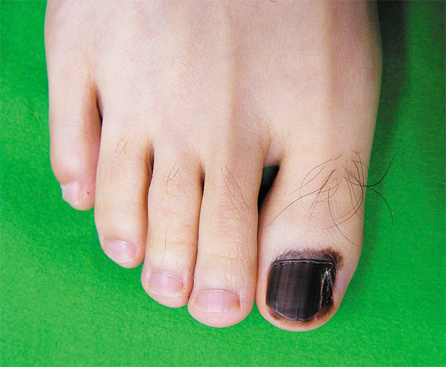 Melanoma