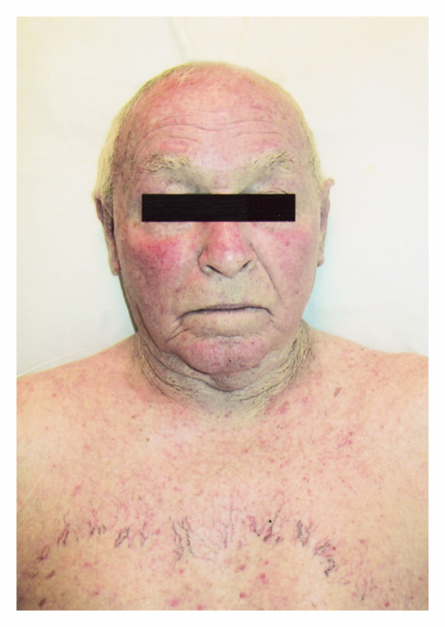 Superior vena cava syndrome