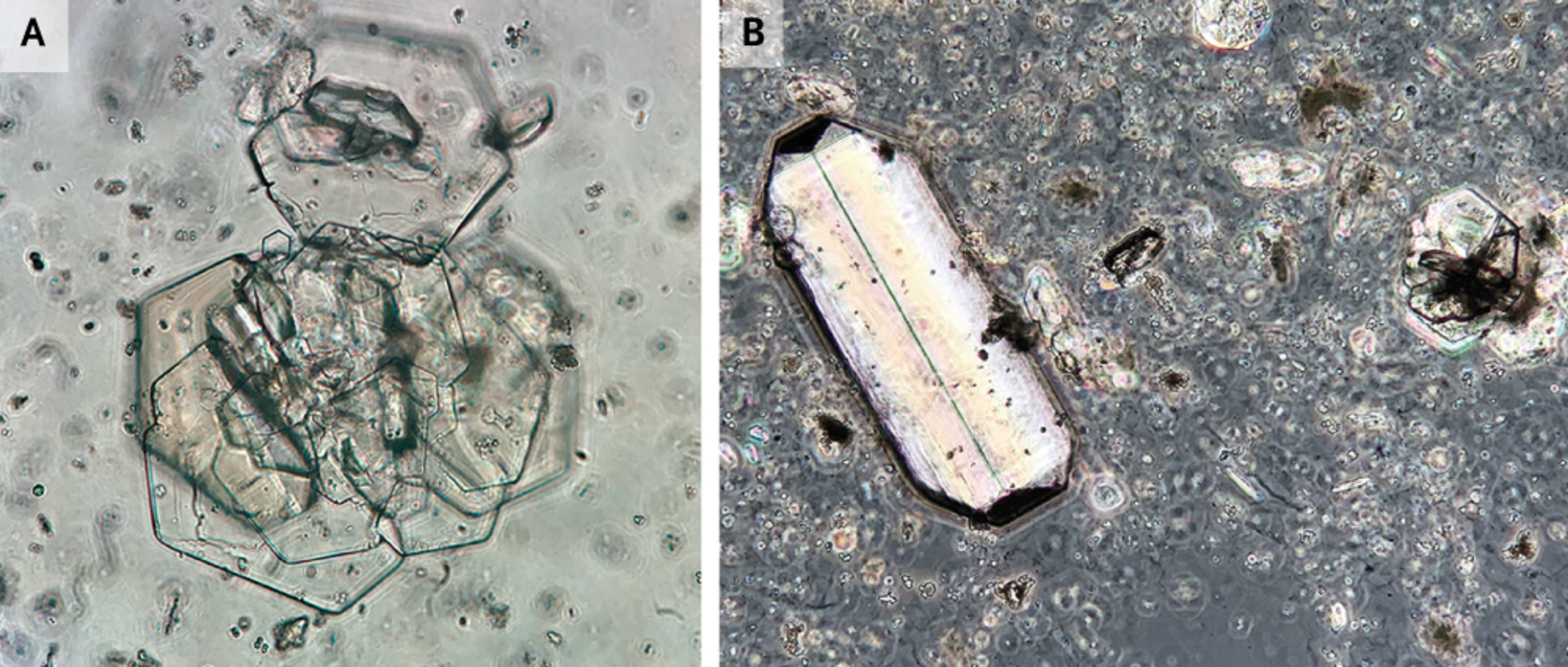 Cystine and triple phosphate (struvite) crystals