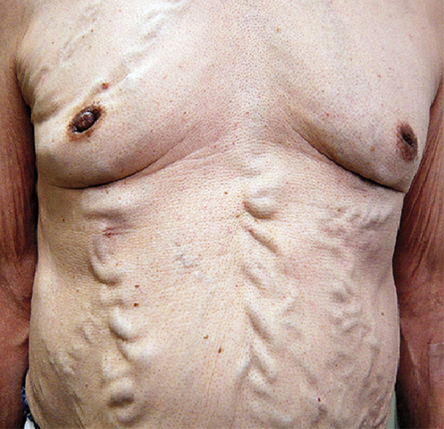 Superior vena caval obstruction