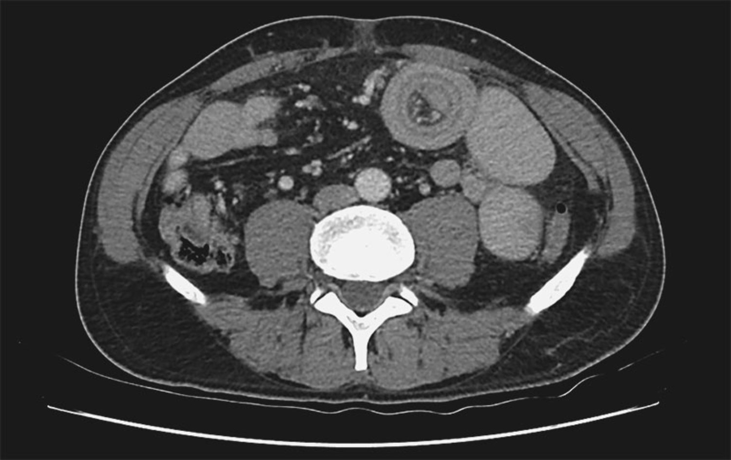 Intussusception