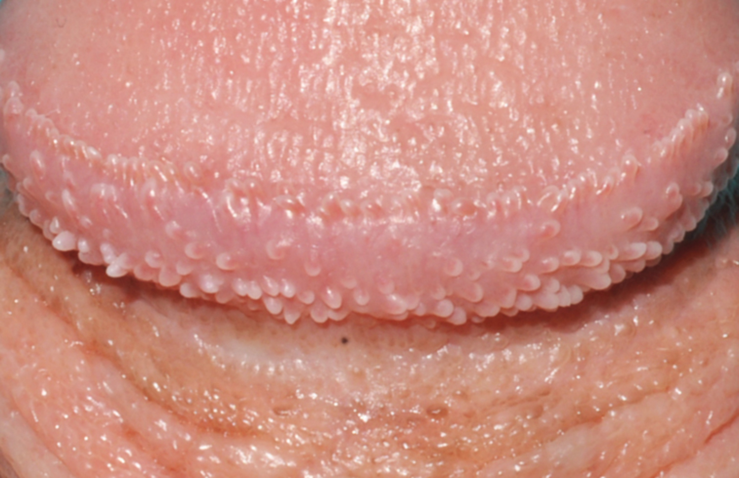Pearly penile papules