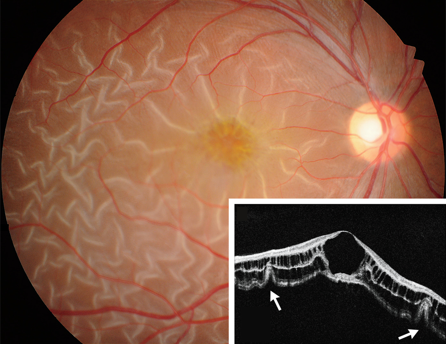 X-linked retinoschisis
