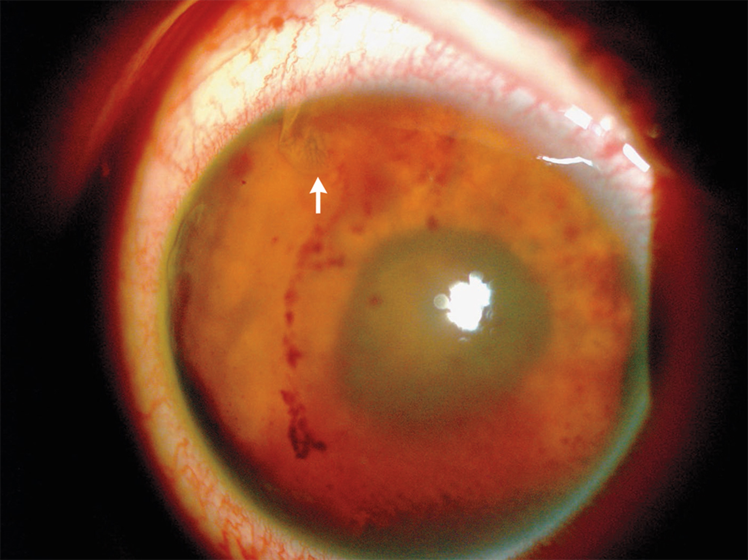 Intraocular parasite infection