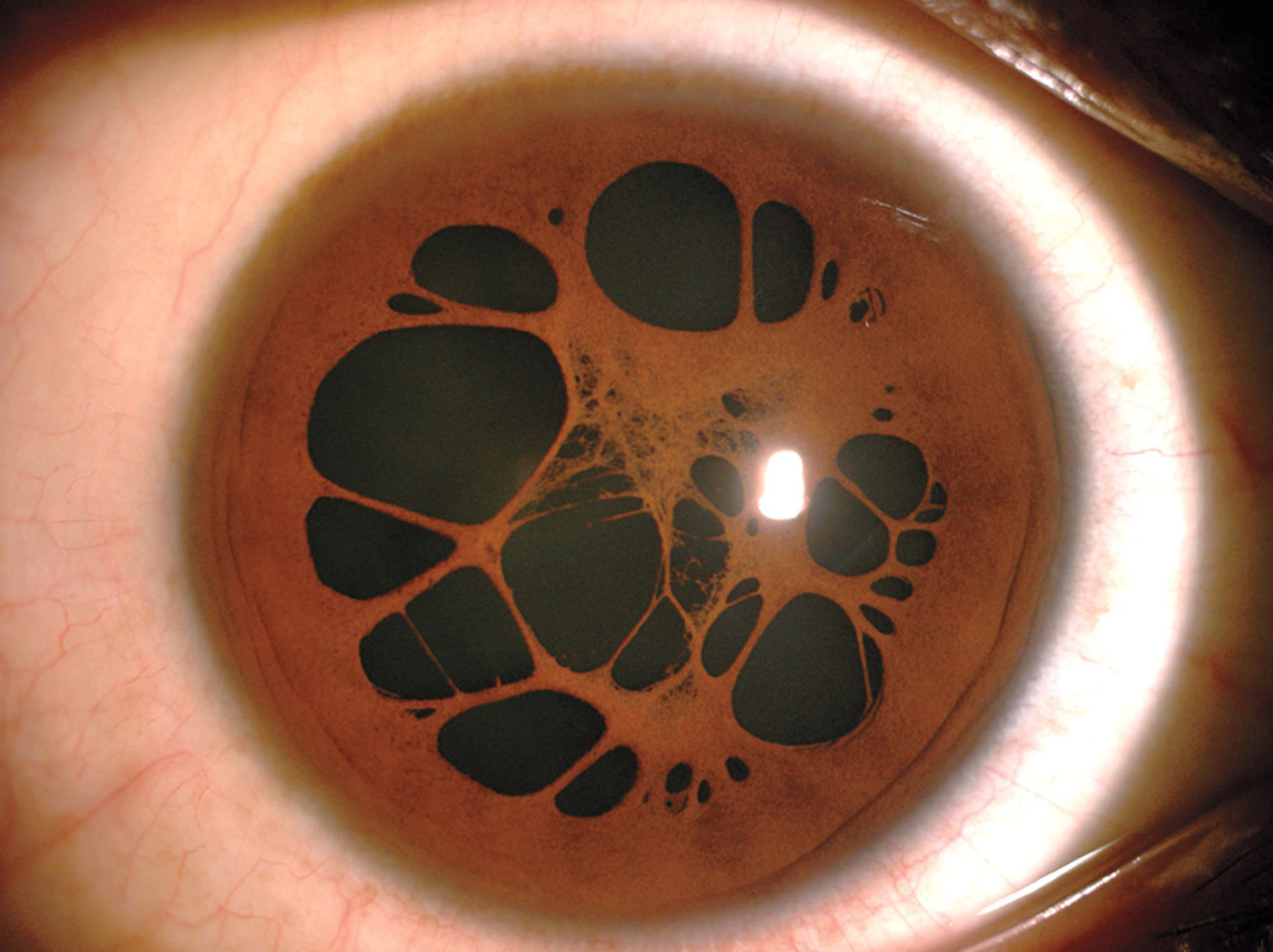 Persistent pupillary membranes