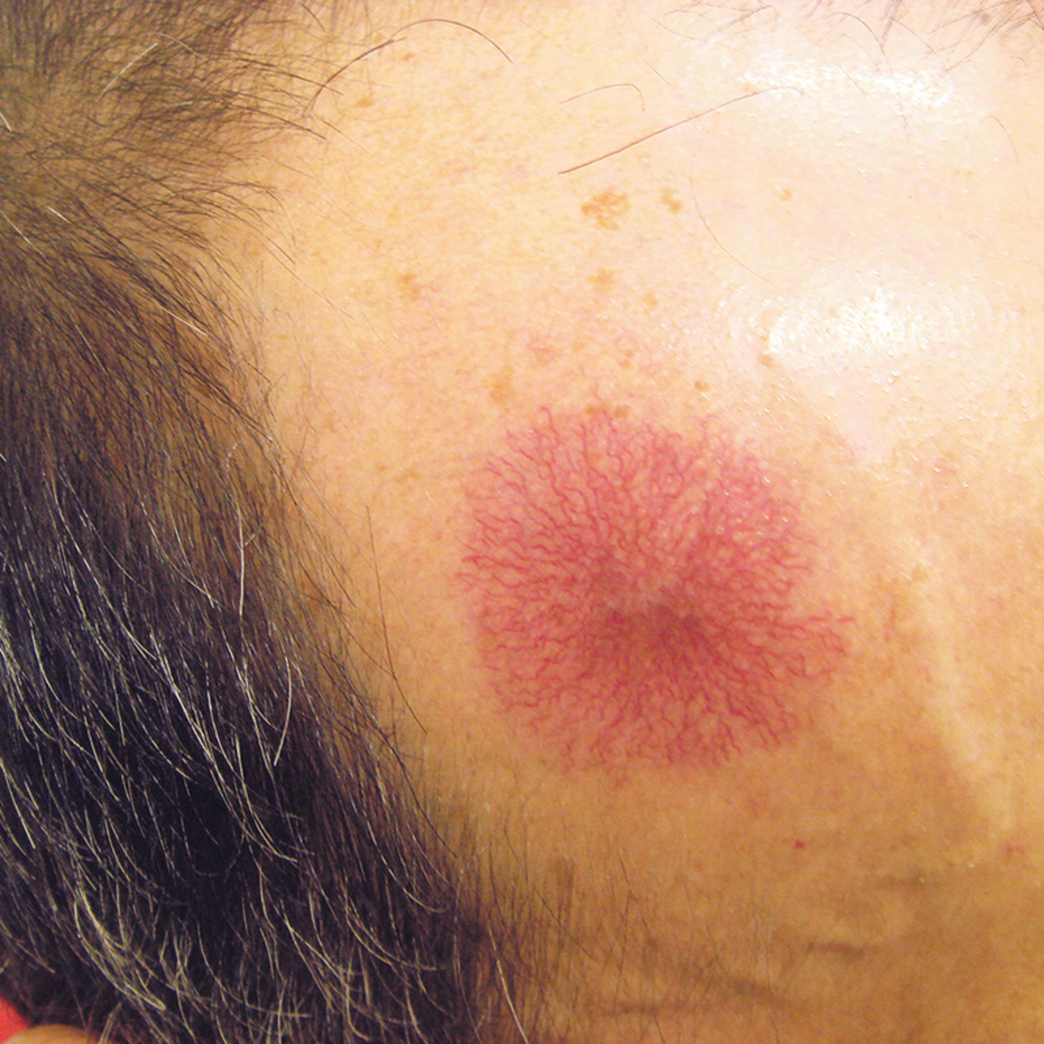 Cirrhosis