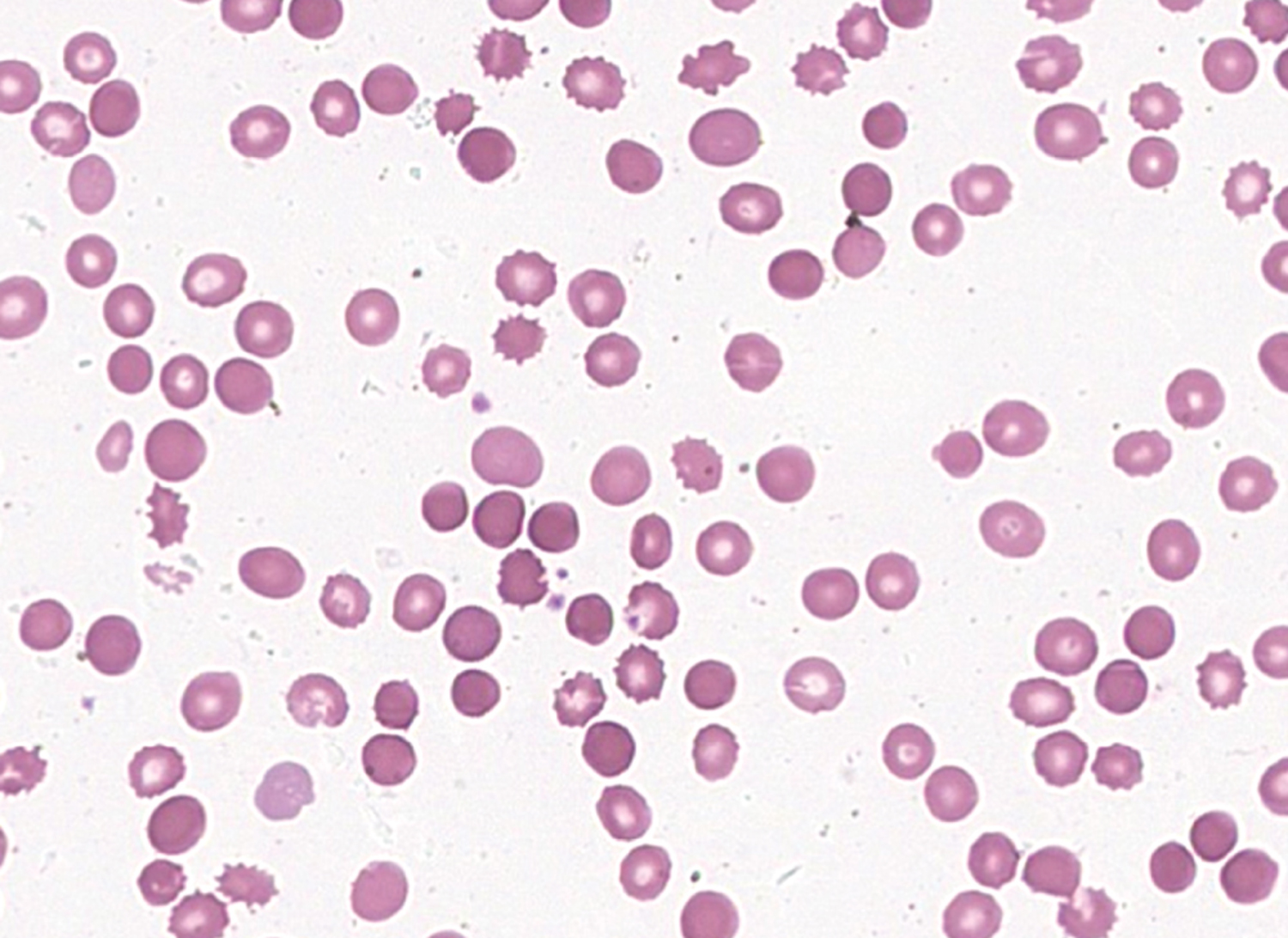 Spur-cell hemolytic anemia