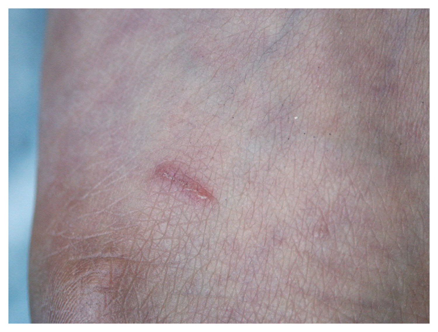 Scabies