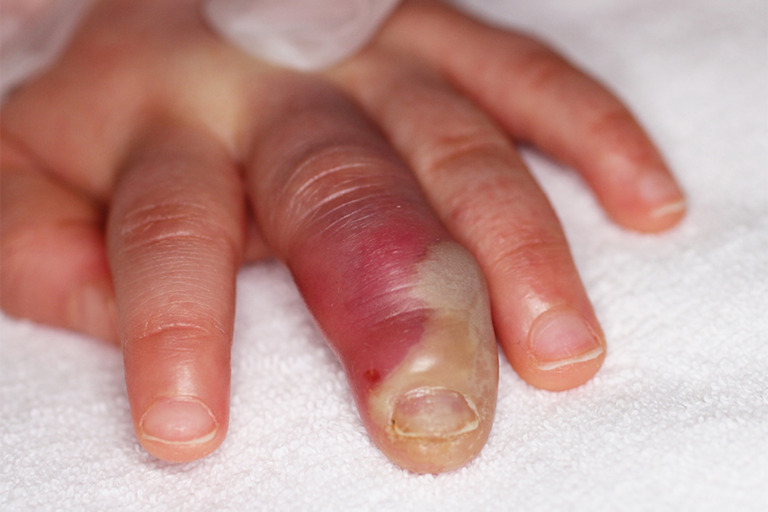 Herpetic whitlow