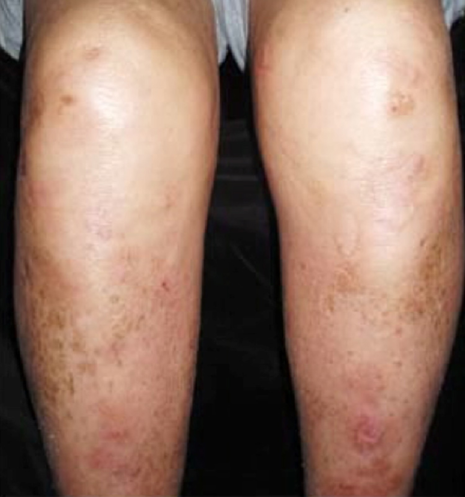Nephrogenic fibrosing dermopathy
