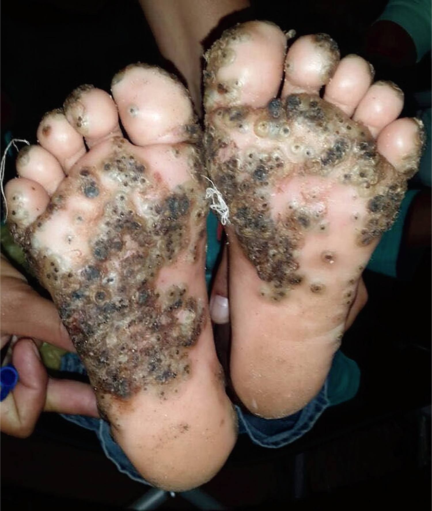 Tungiasis