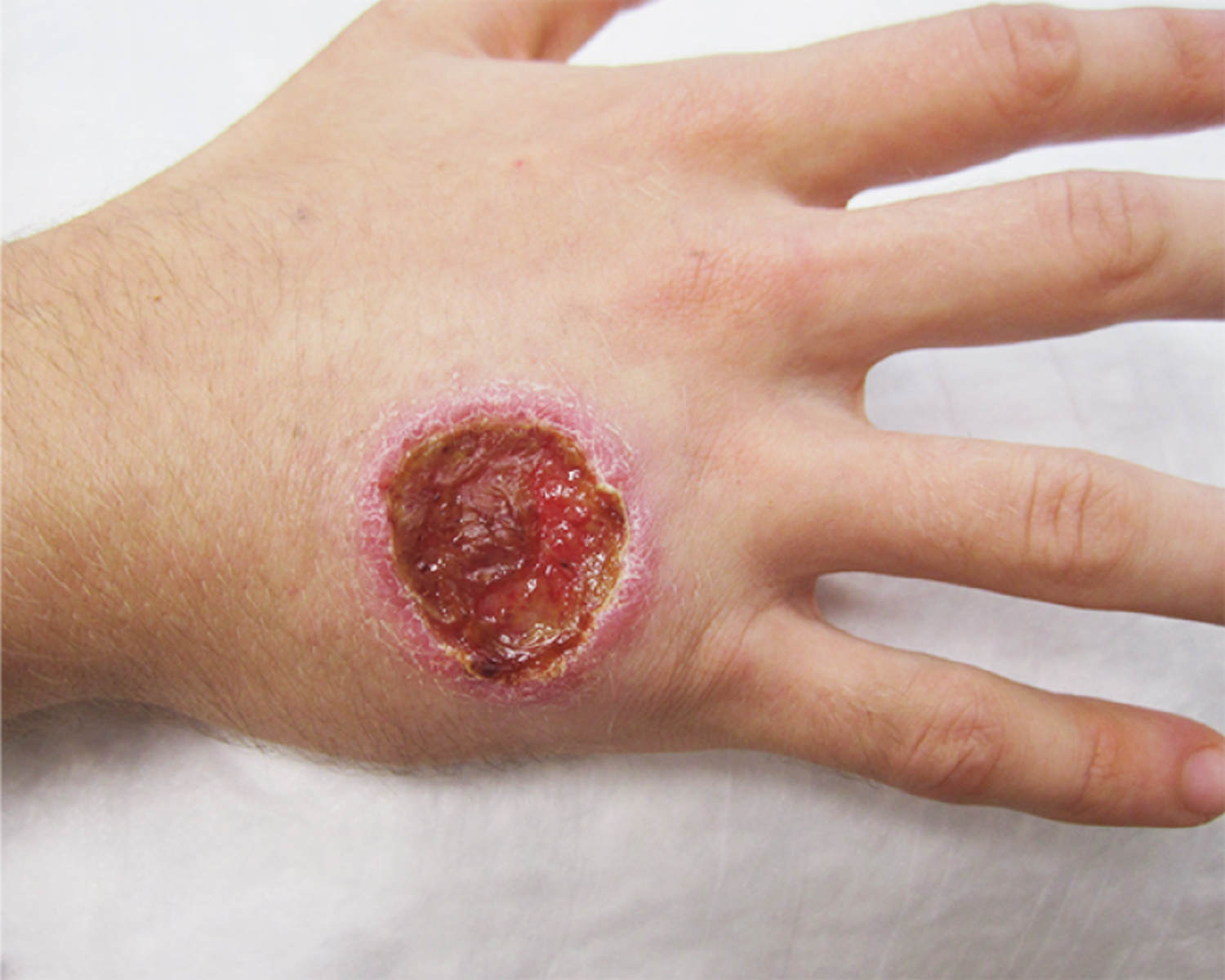 Cutaneous leishmaniasis
