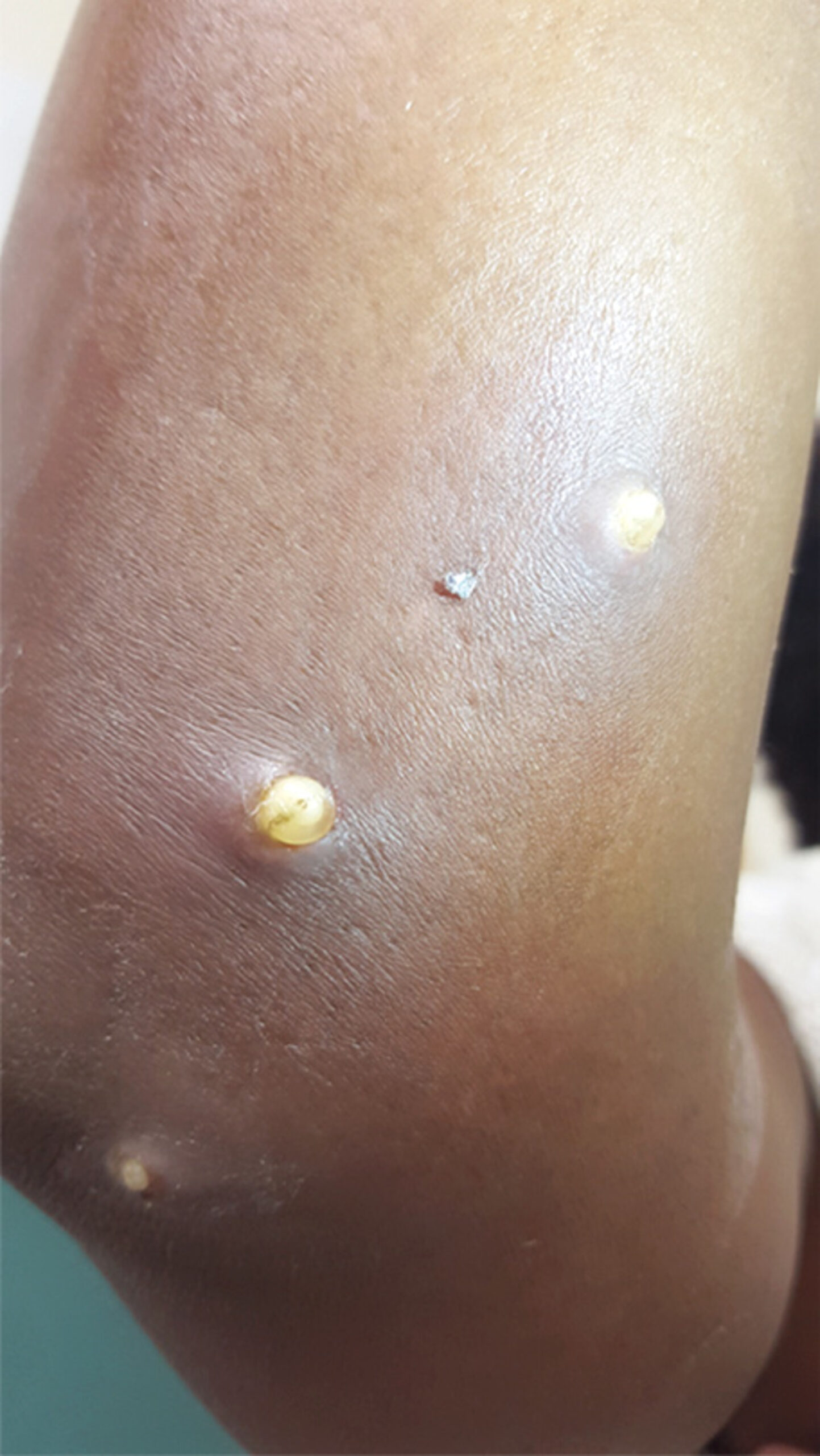Tungiasis