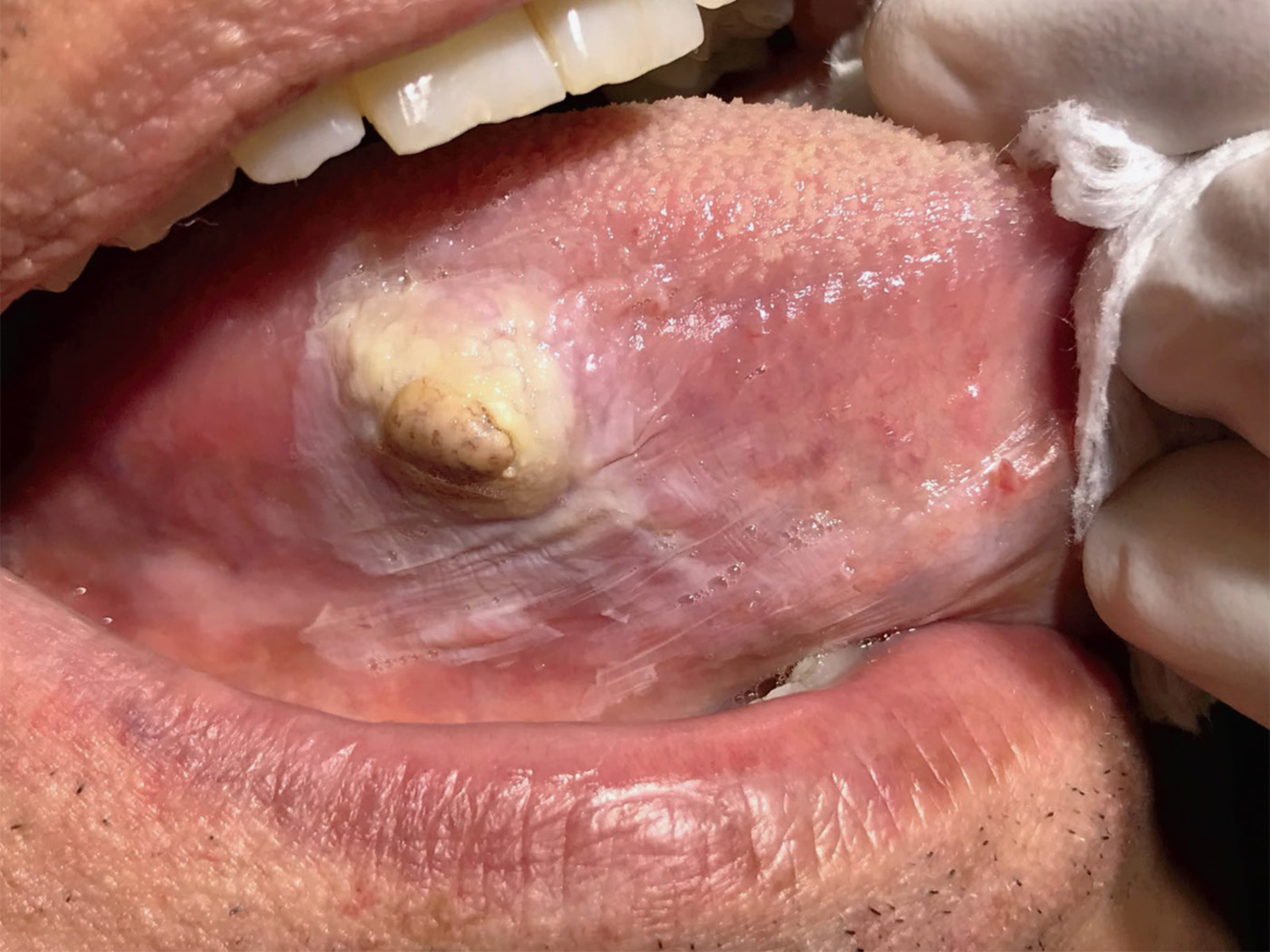 Spindle-cell sarcoma