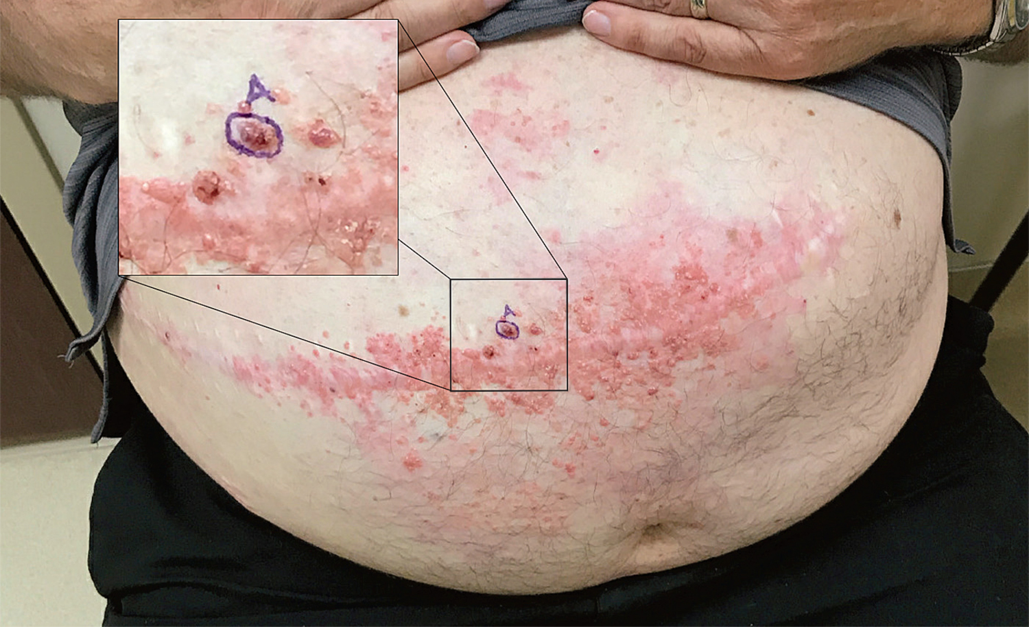 Cutaneous metastases
