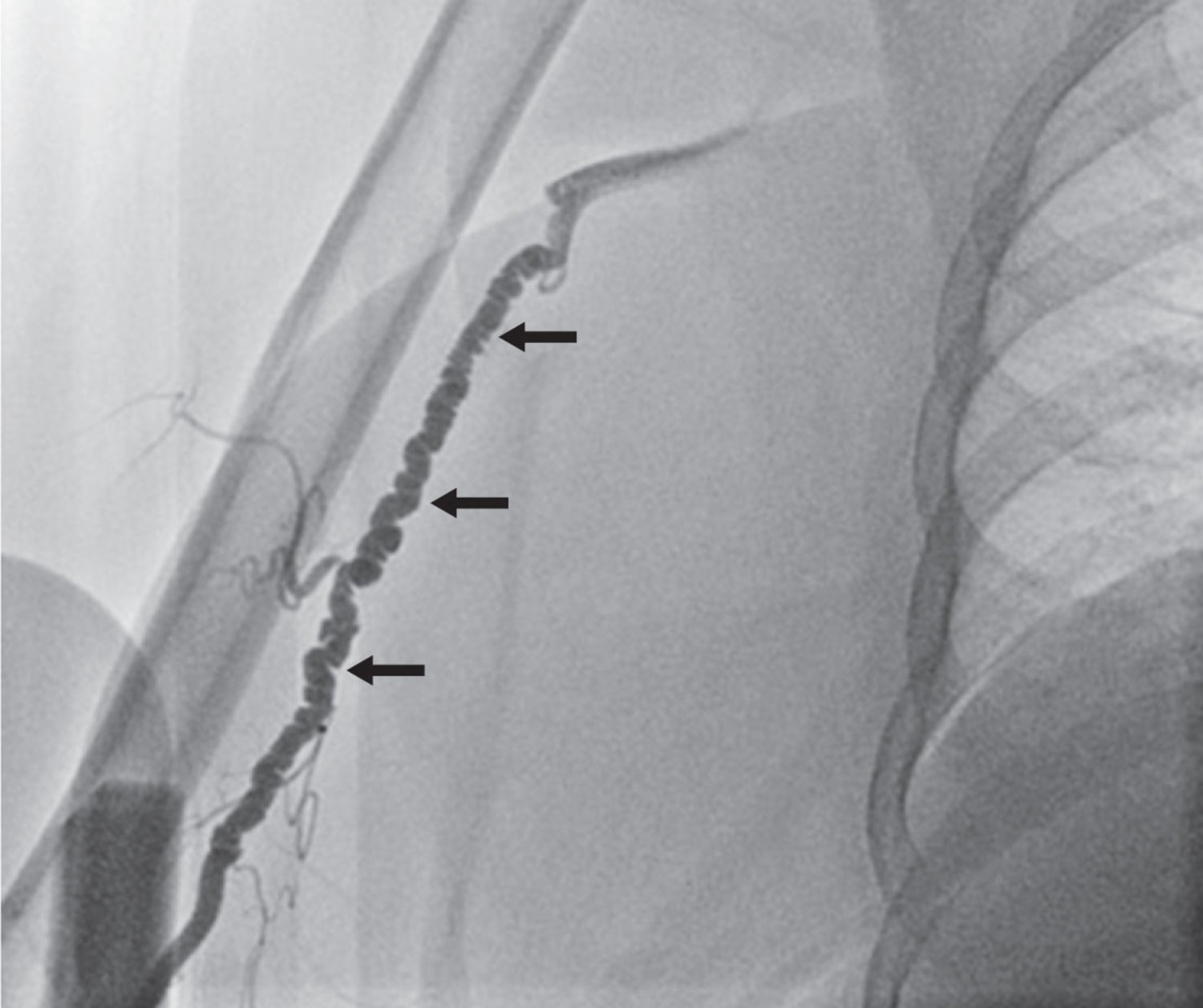 Fibromuscular dysplasia