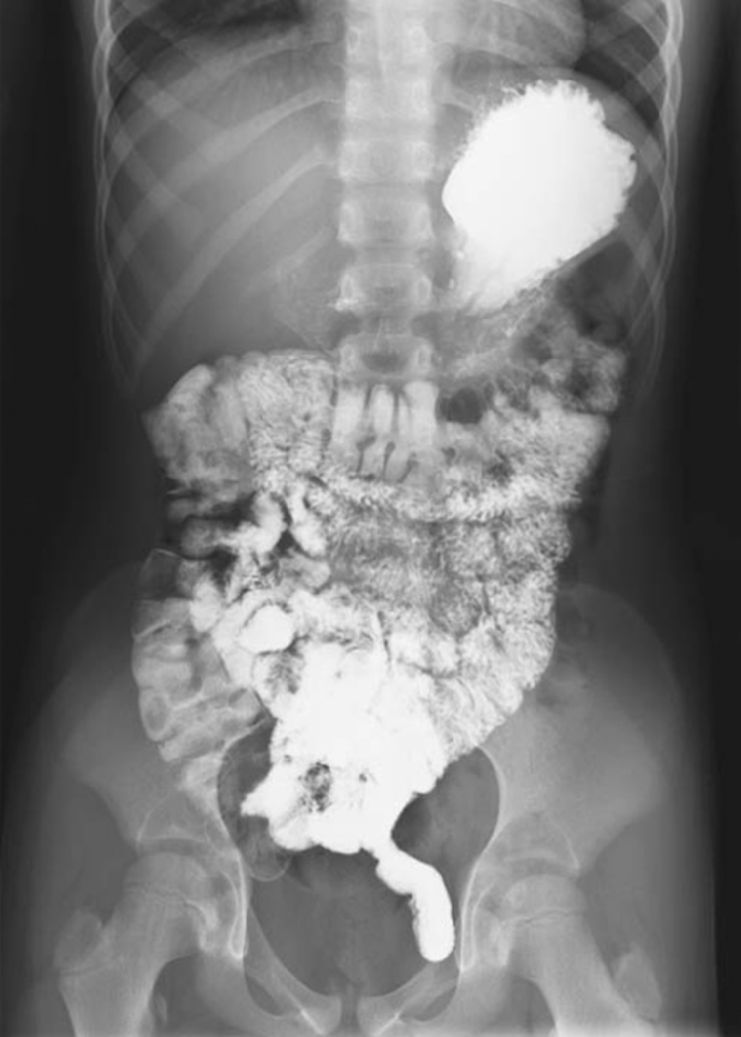 Meckel's diverticulum
