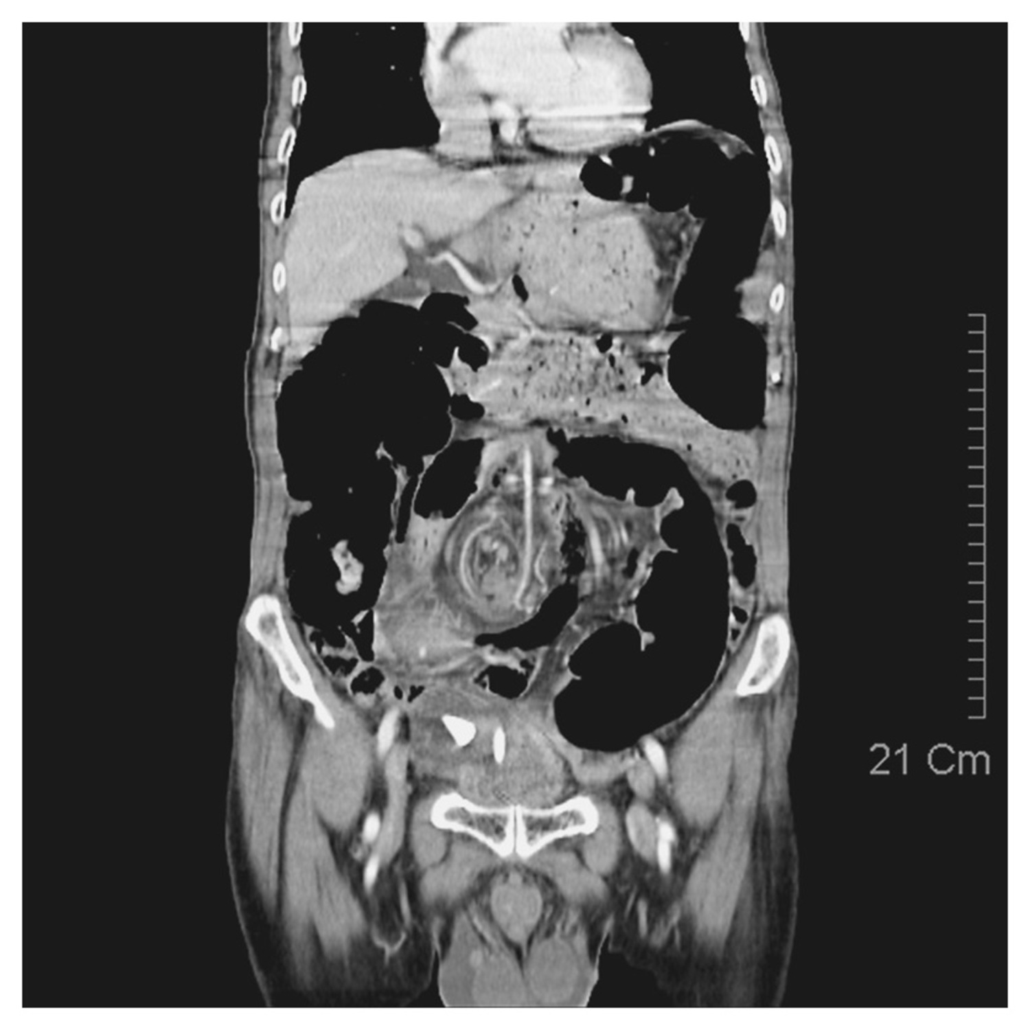 Sigmoid volvulus
