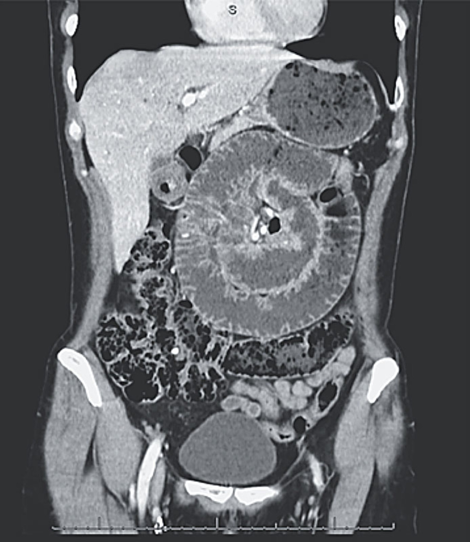 Small-bowel volvulus