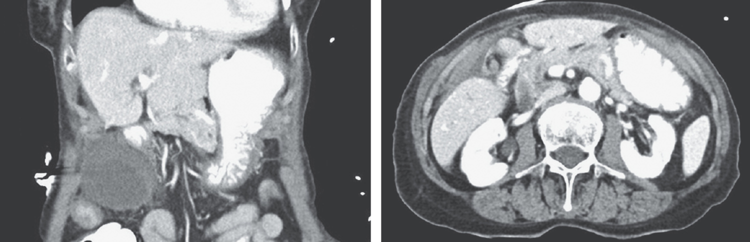 Gallbladder volvulus