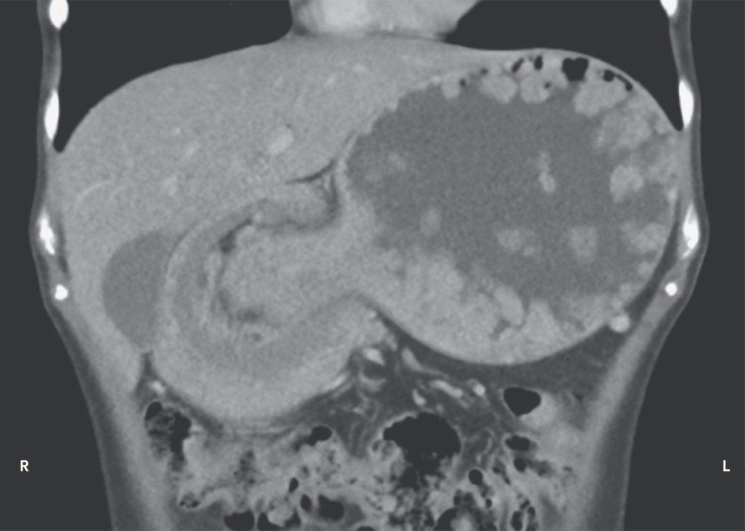 Gastrogastric intussusception