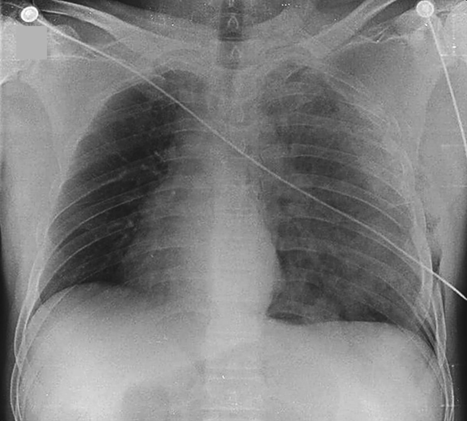 Tension pneumothorax