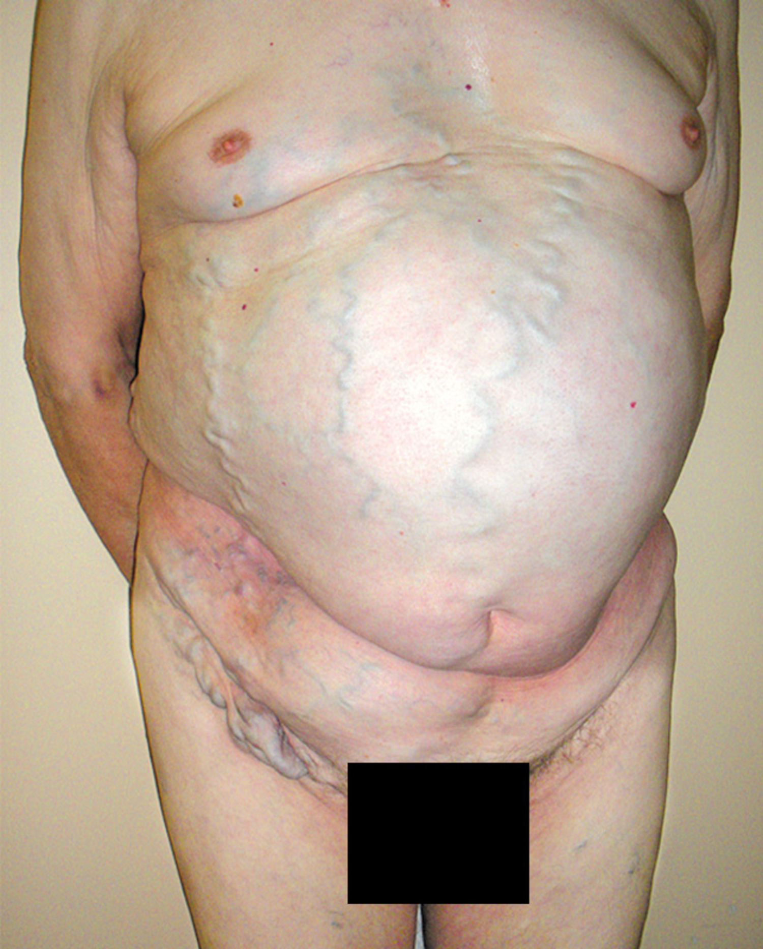 Thrombosis of the inferior vena cava
